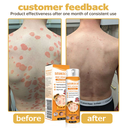 Seurico™ Bee Venom Psoriasis Treatment Spray  🔥 Limited-time offer 60% 🔥