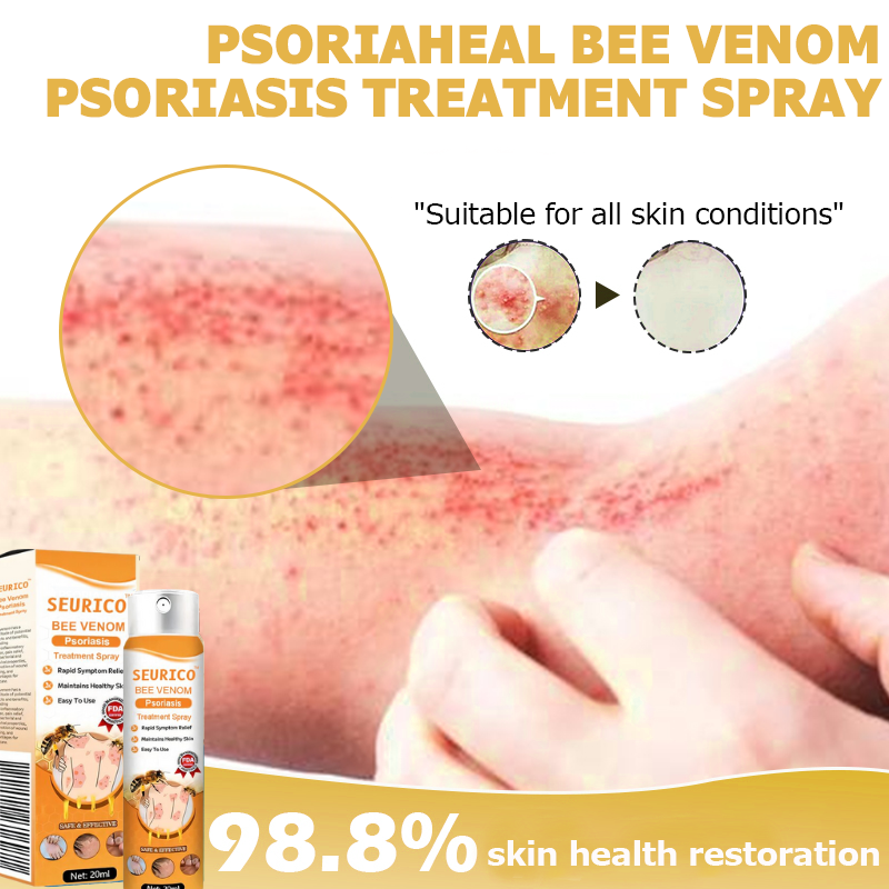 Seurico™ Bee Venom Psoriasis Treatment Spray  🔥 Limited-time offer 60% 🔥