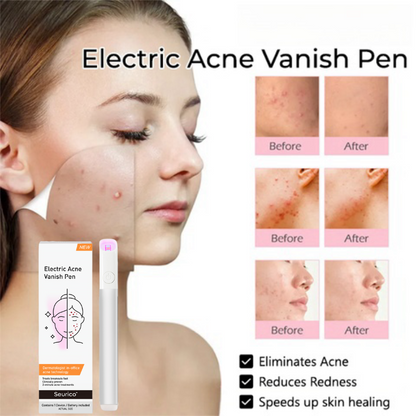 Seurico™ Electric Acne Vanish Pen