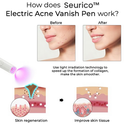 Seurico™ Electric Acne Vanish Pen